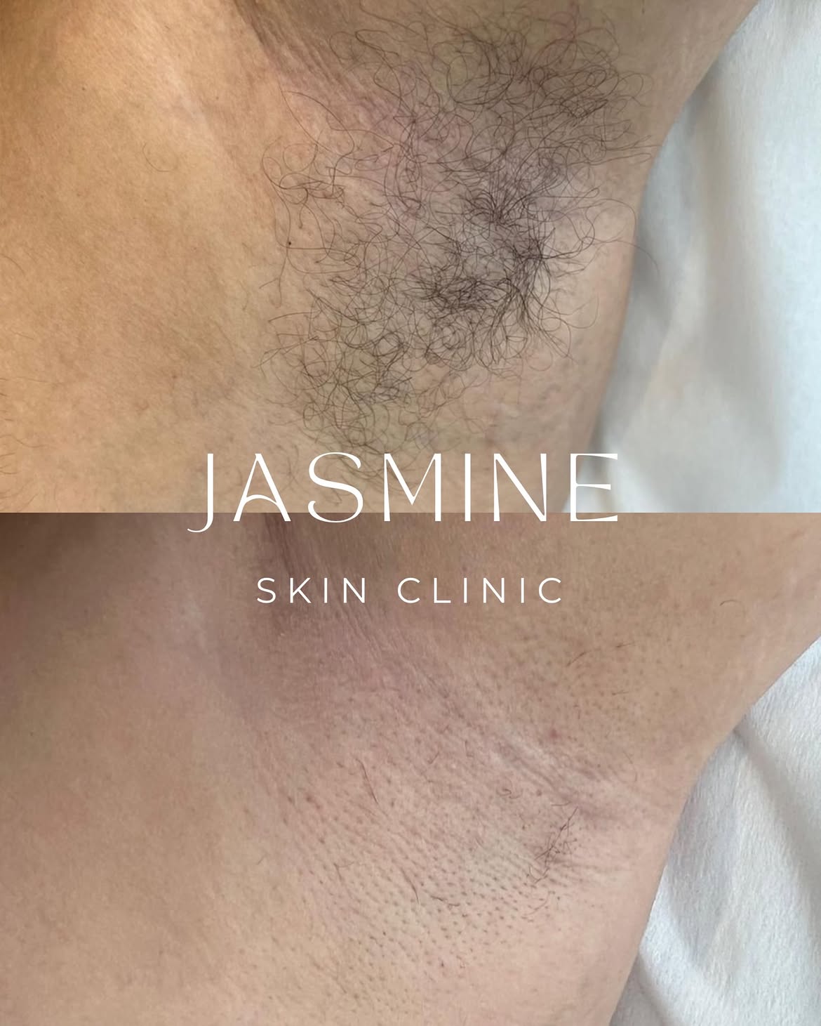 Avant après épilation laser authentique publié par Jasmine Skin